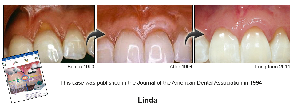 gum recession treatment Chicago